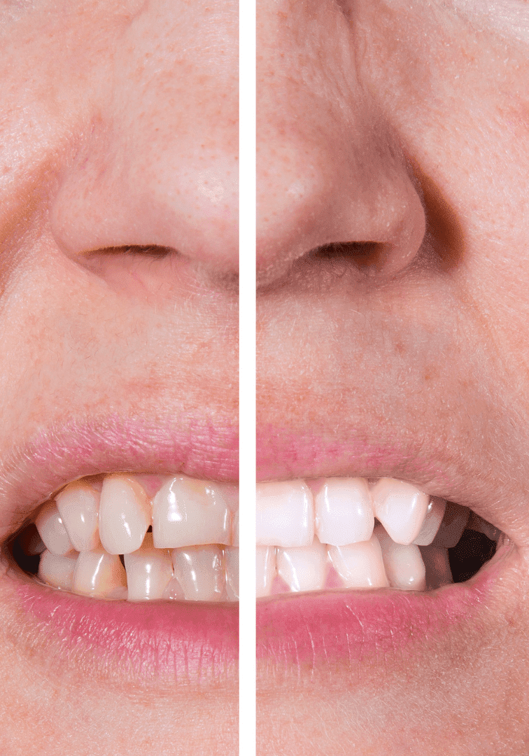 teeth whitening 5-min