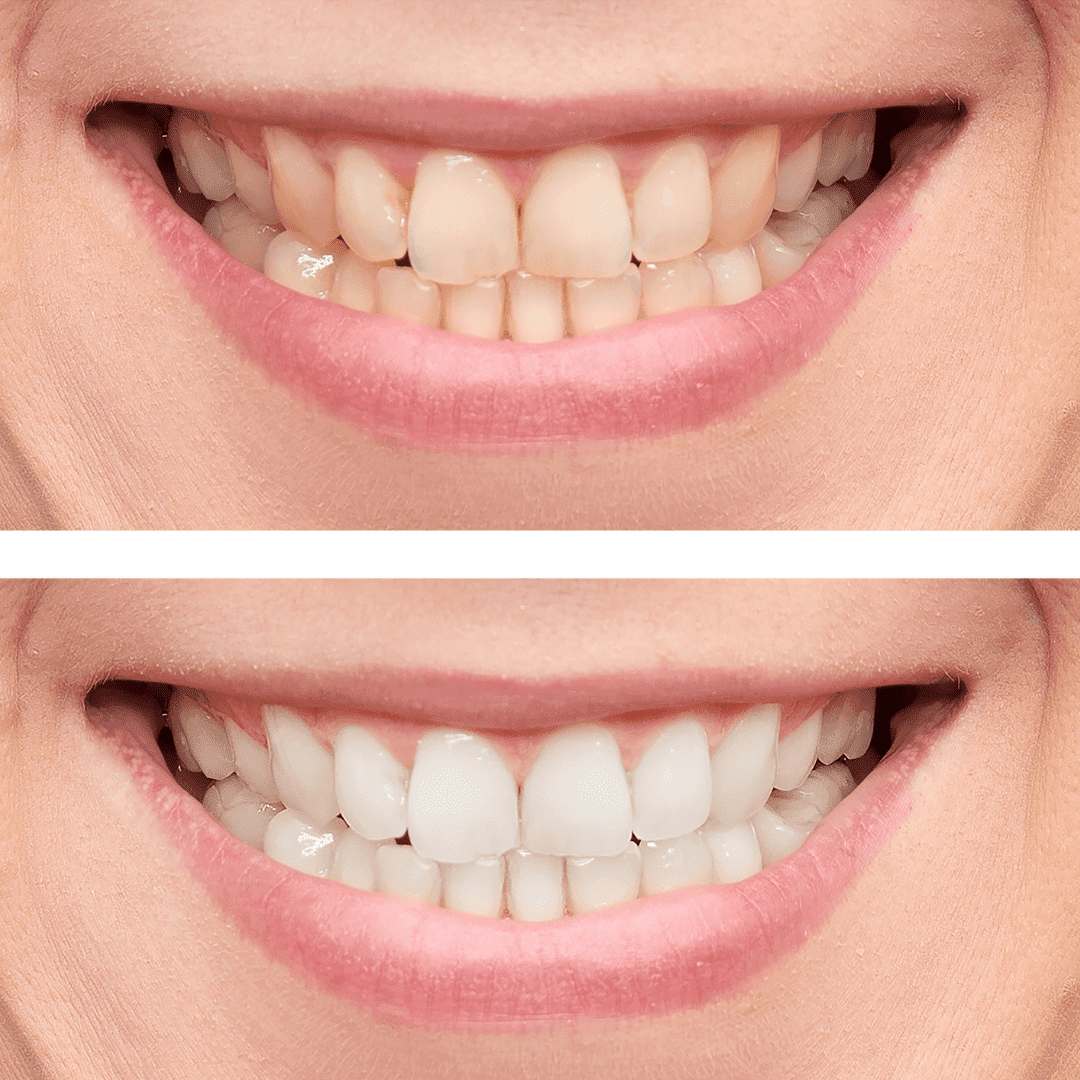 teeth whitening 6-min